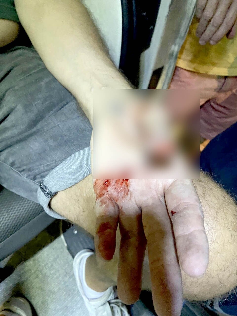 Ausländer stolpert, Hand von Drahtseil in Pattaya aufgespießt